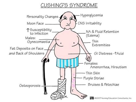 Resultado De Imagen Para Cushing Medcomic Cushings Syndrome Nursing