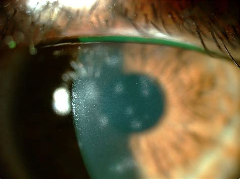 Figure 1 From Photorefractive Keratectomy With Mitomycin C For The