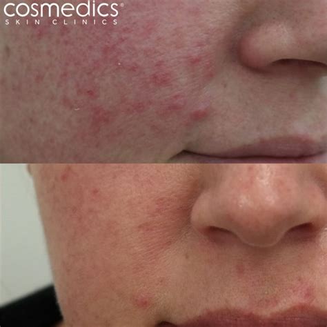 Laser Treatment On Face Before And After Your Magazine Lite