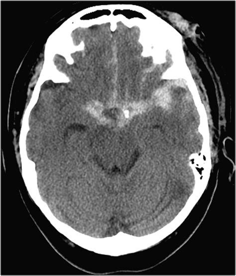 Figure From Diffuse Subarachnoid Hemorrhage Secondary To Cerebral My