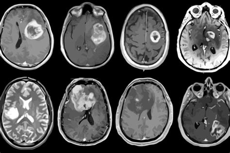 Aggressive Brain Tumor Mapped In Genetic Molecular Detail Washington University School Of