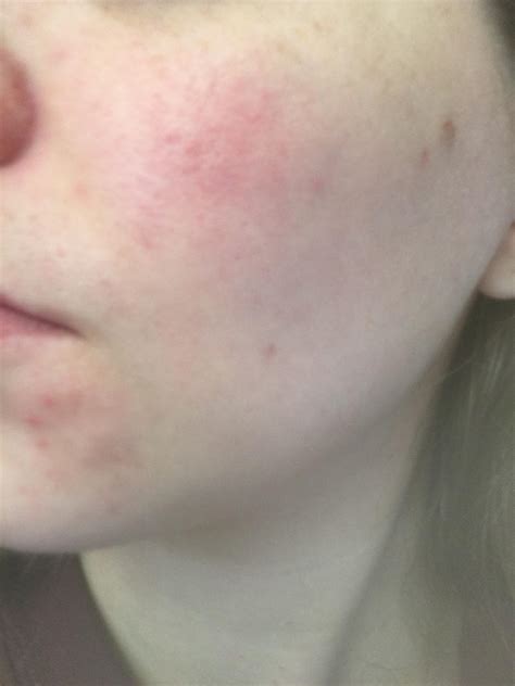 Skin Concerns All Of A Sudden My Left Cheek Is Irritated Red And