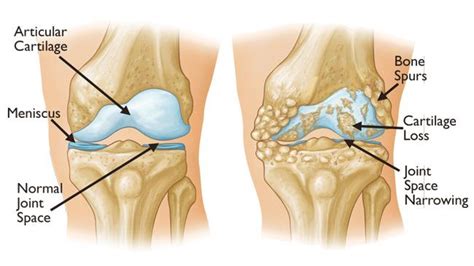 Knee Pain Conditions Lake Nona Medical Arts Arthritis Help