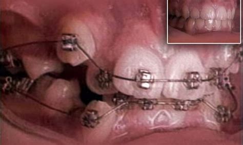 Time Lapse Video Shows A Braces Impact On Crooked Teeth Over 18 Months