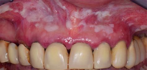 Multiple White Lesions Dentistry33