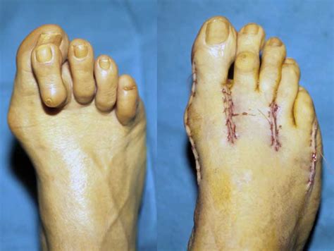Corrective Foot Surgery Weird Picture Archive