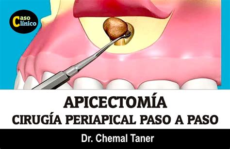 ApicectomÍa Cirugía Periapical Paso A Paso Dr Chemal Taner