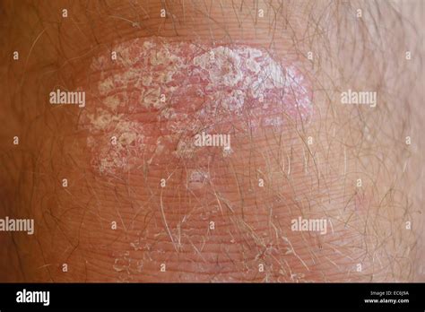 Psoriasis On The Knees Stock Photo Alamy