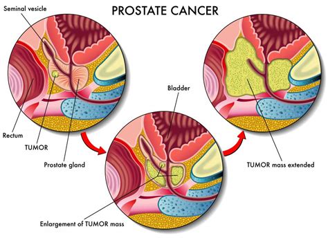Cancer Of The Prostate Gland Detect It Early Take CHARGE Health