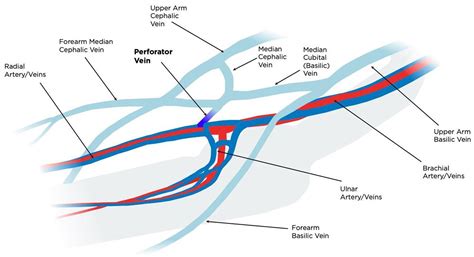 Novel Classification Of Proximal Forearm Perforator Vein In The