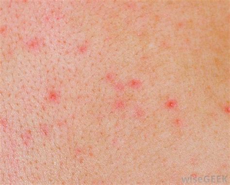 Red Itchy Rashes On Skin How To Choose And Use The Best