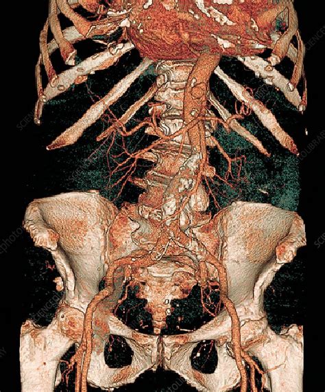 Calcified Aortic Artery 3d Ct Scan Stock Image C0104626 Science