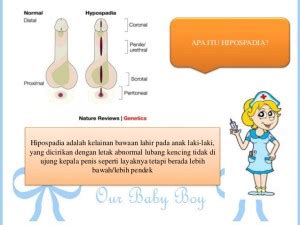 Saat dilahirkan, aprilia manganang mengalami kelainan dalam sistem reproduksinya. Pediatrik Urologi - Urologi RSCM