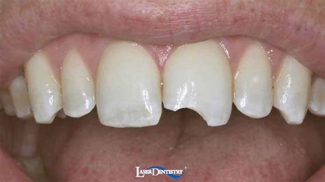 Cosmetic Dentistry Laser Dentistry