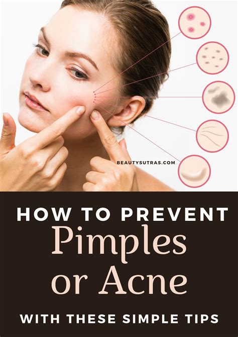 How To Prevent Pimples Or Acne Tips And Home Remedies Beautysutras