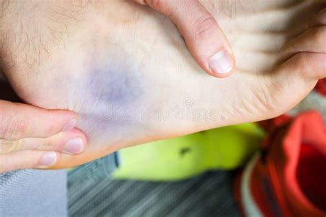 Bruise Near Ankle Stock Image Image Of Barefoot Purple 100401535