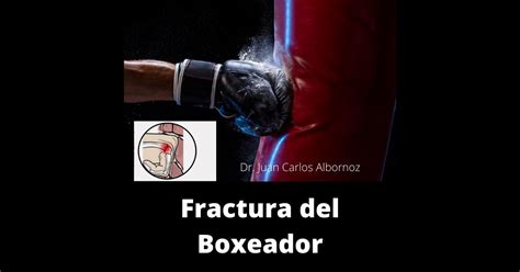Fractura Del Boxeador Tutraumatologocom