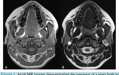 Figure 1 From A Rare Case Of Synchronous Bilateral Pleomorphic Adenoma