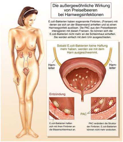 Harnwegsinfekt Ursachen Beschwerden Therapie Gesundpedia De