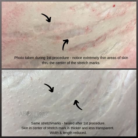 Stretch Mark And Scar Revision Results • About Face And Body