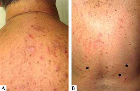 Scielo Brasil Acquired Perforating Dermatosis In A Patient With