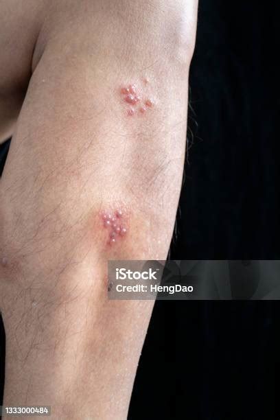 Fungal Infection Called Tinea Corporis In Leg Widespread Ringworm Over