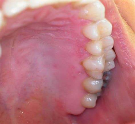 Herpes Simplex Virus Hsv Infection Of The Mouth European