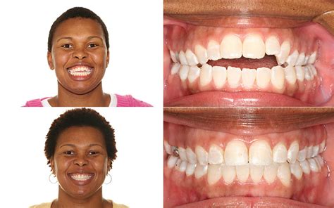 Before And After Orthocare Orthodontics Charlotte Nc Spartanburg Sc