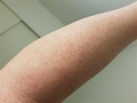 Scabies Or Eczema Rskincareaddicts