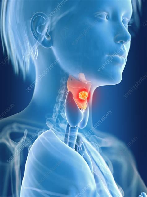Illustration Of Female Larynx Cancer Stock Image F0233945