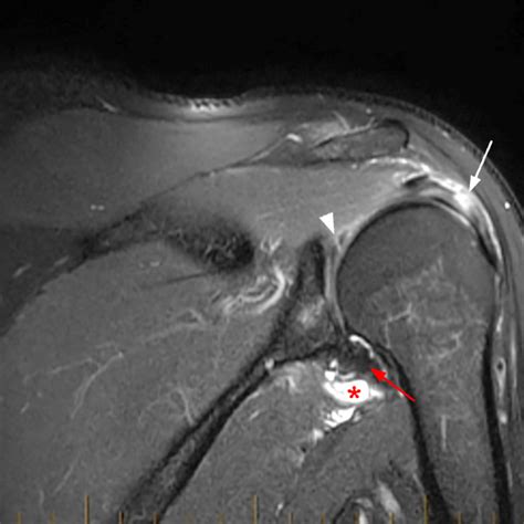 Shoulder Cysts Radsource