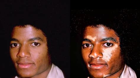 Vitiligo Michael Jackson Before And After