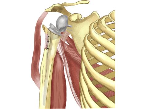 Latissimus Dorsi Tendon Transfer In Reverse Shoulder Arthroplasty