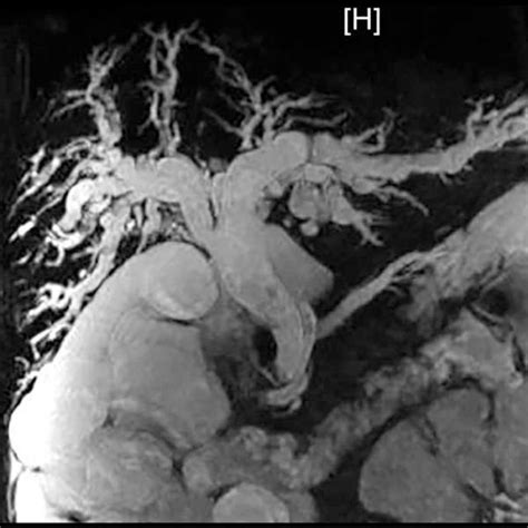 Endoscopic Retrograde Cholangiopancreatography Revealed Diffuse