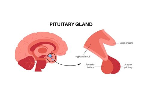 why is it so hard to treat a pituitary tumor