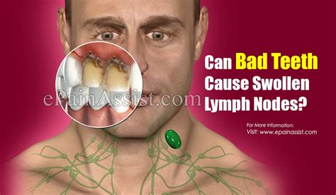 Can Bad Teeth Cause Swollen Lymph Nodes