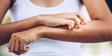 Itchy Inside Elbow Atopic Dermatitis Eczema Symptoms And Causes