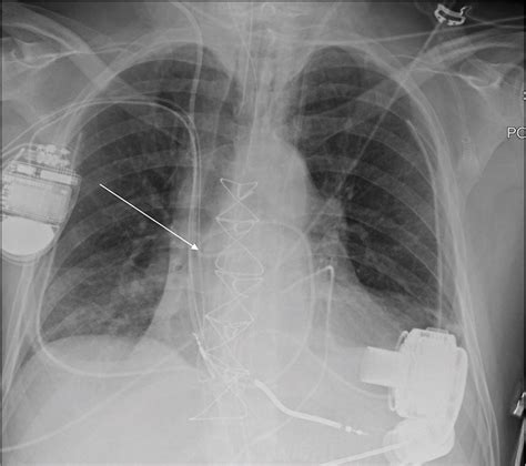 Malpositioned Lines And Tubes On Chest Radiograph A Concise Pictorial Review Journal Of