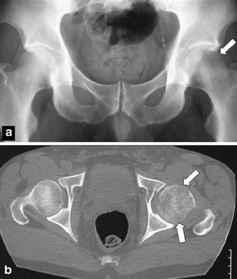 A 40 Year Old Man With Transient Osteoporosis Of The Left Hip A The