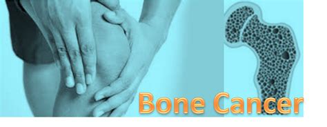 Osteoblast Osteoclast Cancer Painful Bone Metastasis