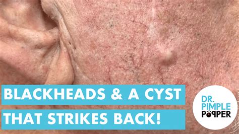 Blackheads And The Cyst That Strikes Back Bedtime Blackheads Dr
