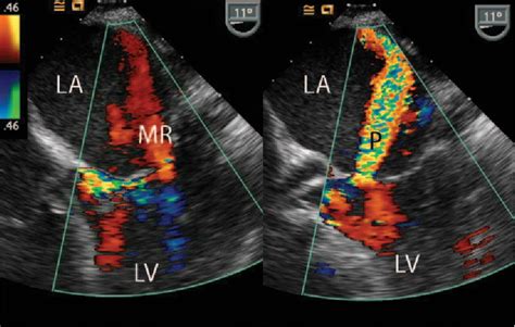 Figure 2 From Echocardiographic Recognition Of Mitral Valve Involvement