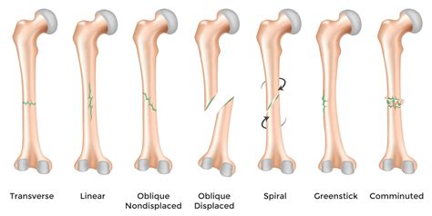 Classification Of Bone Fractures