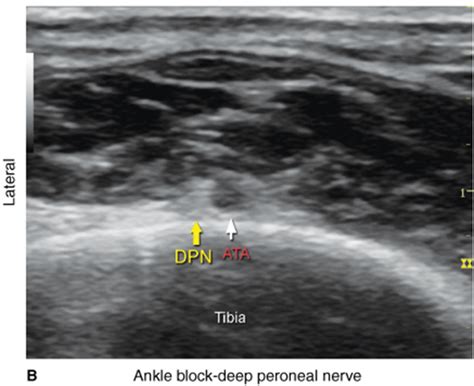 Ultrasound Guided Ankle Block Hadzics Peripheral Nerve Blocks And