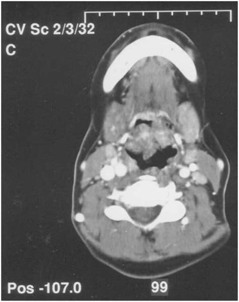 Fig1atypical Presentation Of Hiv In A Pregnant Patient Open I