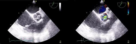Quadricuspid Aortic Valve By Transesophageal Echocardiography Auctores