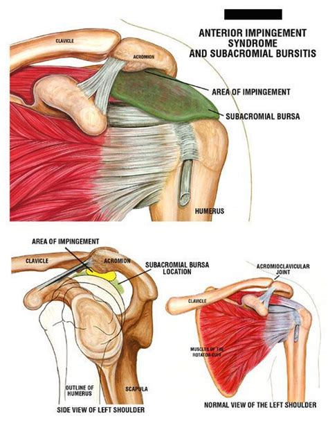 Shoulder impingement is a common problem that can lead to major issues if not nipped in the bud. shoulder impingement | ... , depicting Shoulder ...