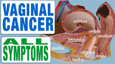 Vaginal Cancer All Symptoms YouTube