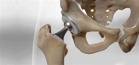 Hip Replacement Surgery In Mulund Thane Dr Aditya Pathak