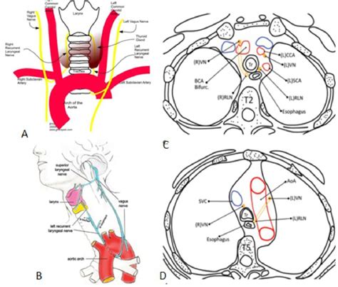 Figure 2 From Unilateral Vocal Cord Paralysis A Review Of